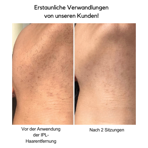 IPL Haarentfernungsgerät™ | Verabschieden Sie sich von unerwünschtem Haar