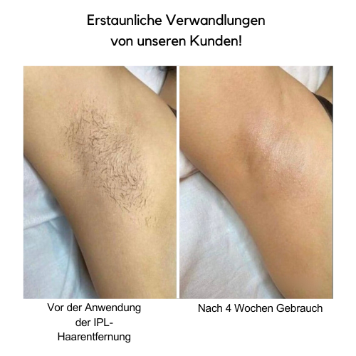 IPL Haarentfernungsgerät™ | Verabschieden Sie sich von unerwünschtem Haar