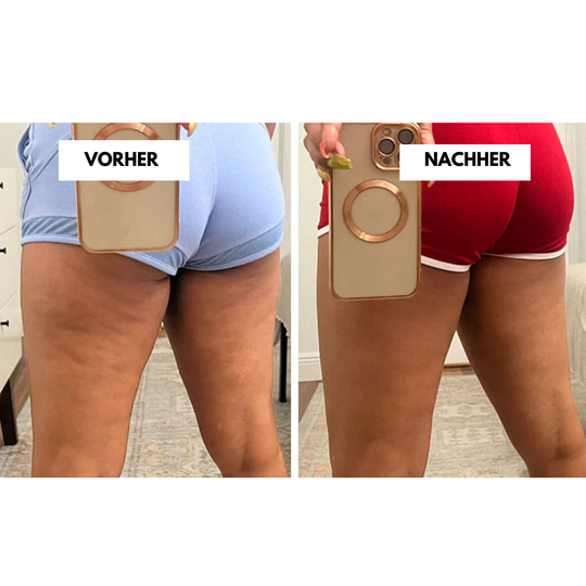 CelluLift™ | Straffen Sie Ihre Haut mit dem Anti-Cellulite-Vakuum-Massager