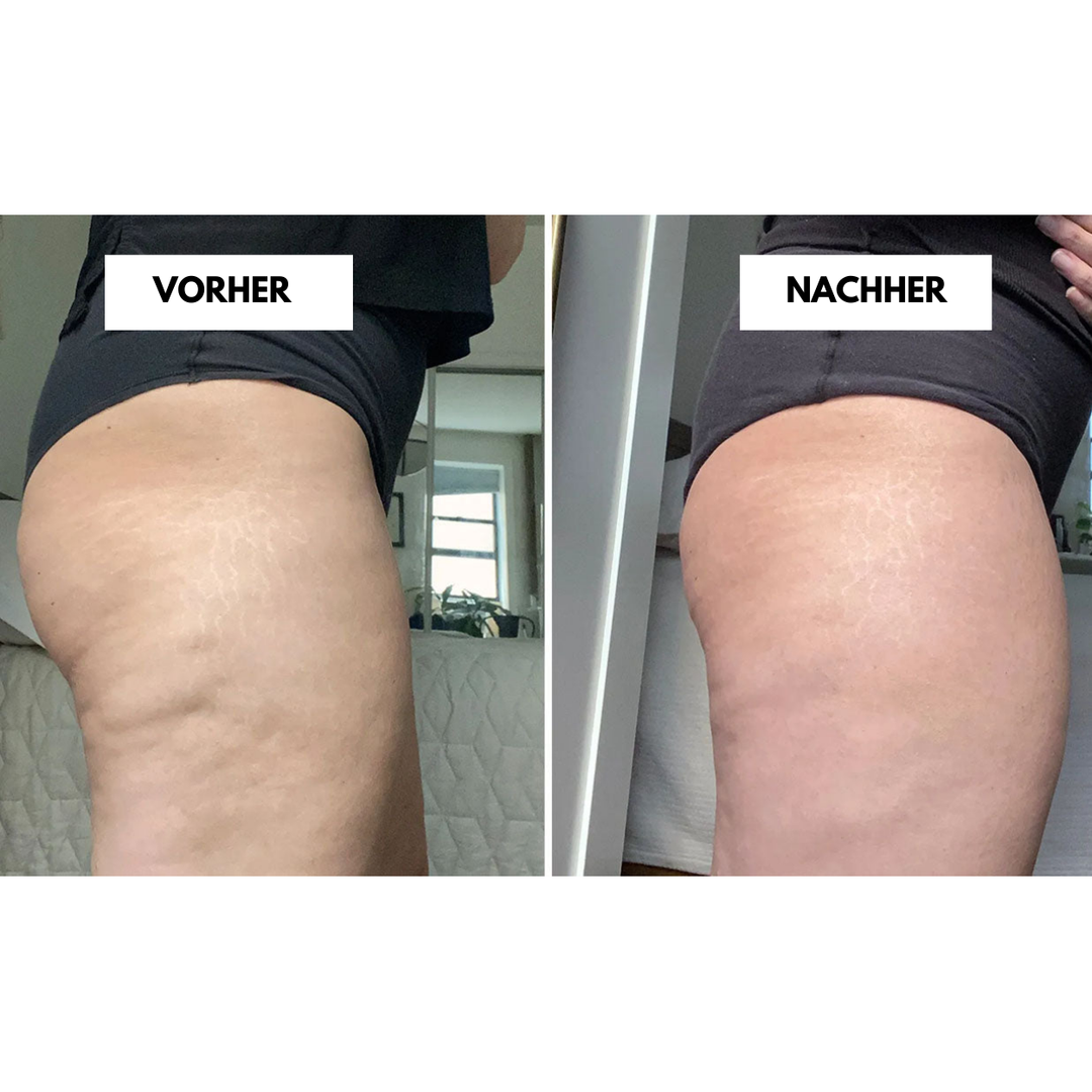 CelluLift™ | Straffen Sie Ihre Haut mit dem Anti-Cellulite-Vakuum-Massager